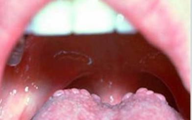 Nổi hột đỏ ở cuống lưỡi là bệnh gì? [3 địa chỉ chữa tốt]