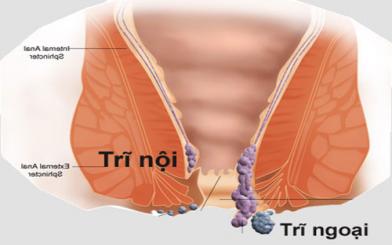 Bệnh trĩ là gì?