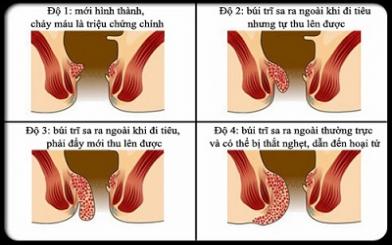 Dấu hiệu của bệnh trĩ 