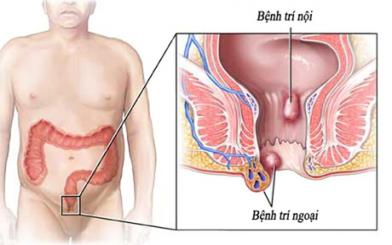 Bệnh trĩ nội là gì?