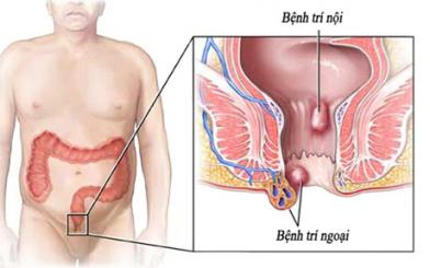 Bệnh trĩ nội là gì?