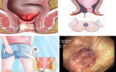 Những điều cần biết về trĩ ngoại độ 2