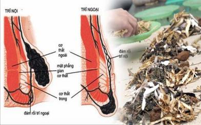 Điều trị bệnh trĩ