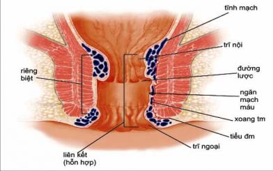 Trĩ hỗn hợp