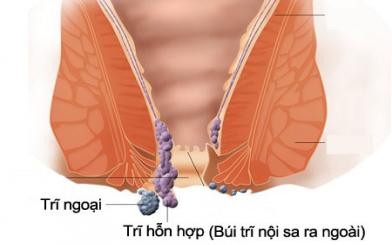 Trĩ hỗn hợp là gì?