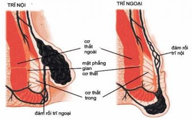 Biến chứng trĩ ngoại