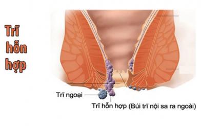 Nguyên nhân trĩ hỗn hợp