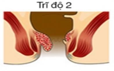 Bệnh trĩ cấp độ 2