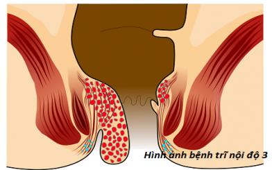 Bệnh trĩ cấp độ 3