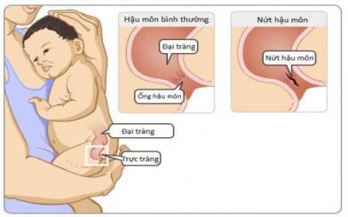 Điều trị nứt kẽ hậu môn ở trẻ em