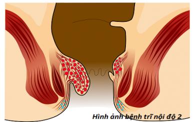 Bệnh trĩ nội độ 2 là gì?