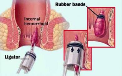 Cách trị bệnh trĩ nội