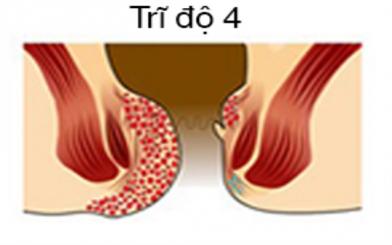 Bệnh trĩ nội độ 4