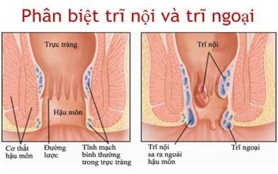 Cách bạn có thể Phân biệt trĩ nội và trĩ ngoại qua các dấu hiệu nhận biết