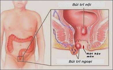 Các loại bệnh trĩ bạn cần biết