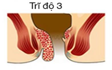 Trĩ độ 3 có cần phẫu thuật không?