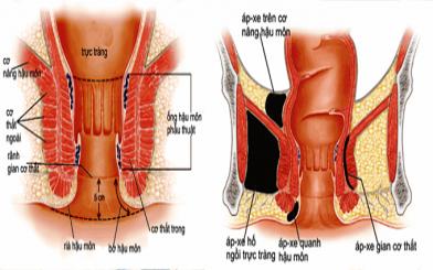 Cách phân biệt áp-xe và rò hậu môn