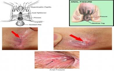 Hình ảnh nứt kẽ hậu môn qua các giai đoạn phát triển