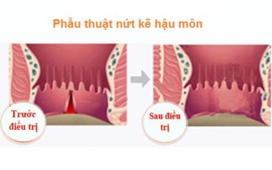 Phẫu thuật nứt kẽ hậu môn có đau không?