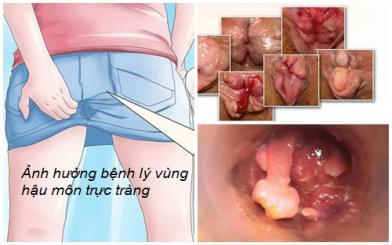 Nguyên nhân khó đi ngoài ở người lớn