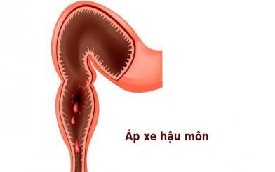 Apxe hậu môn là gì?