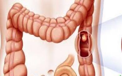 Polyp hậu môn là gì?