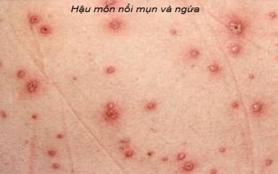 Hậu môn nổi mụn và ngứa do đâu?