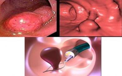 Cách chữa bệnh polyp hậu môn hiệu quả nhất