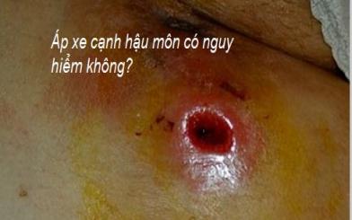 Apxe cạnh hậu môn có nguy hiểm không? 