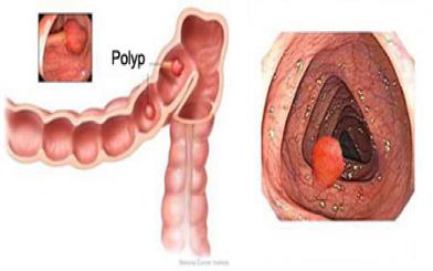 Biểu hiện polyp hậu môn không nên chủ quan 