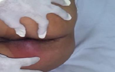 Bé bị đỏ hậu môn có nguy hiểm không?