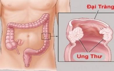 6 biến chứng polyp hậu môn không nên chủ quan