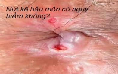 Nứt kẽ hậu môn có nguy hiểm không?