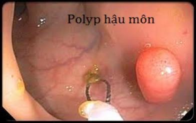 Dấu hiệu u nhú hậu môn tái phát là gì?