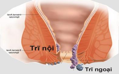 Tác hại của bệnh trĩ đối với sức khỏe