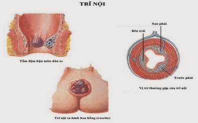 Chữa trĩ nội ở đâu tốt nhất Hà Nội?