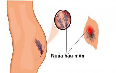 Những sự thật về chứng ngứa rát hậu môn