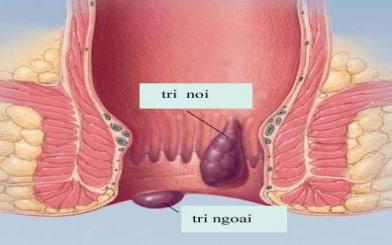 Bệnh trĩ có trị hết không?