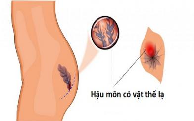 Một số nguyên nhân hậu môn có vật thể lạ