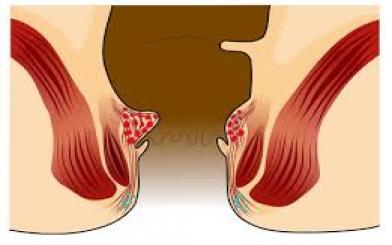 Cách chữa trĩ nội độ 1 không cần dùng thuốc