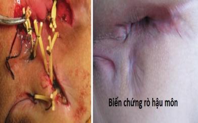Những biến chứng rò hậu môn bạn không biết