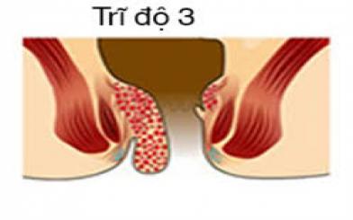 Bệnh trĩ độ 3 có nên đi phẫu thuật không?