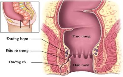 Rò hậu môn trực tràng có nguy hiểm không?