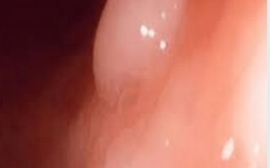 Điều trị bệnh u nhú hậu môn có đắt không?