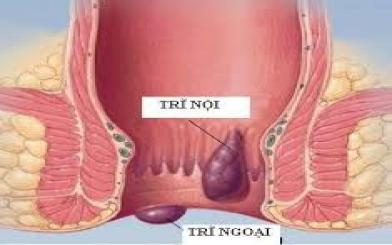 Đi ngoài ra máu kèm dịch nhầy là bệnh gì?