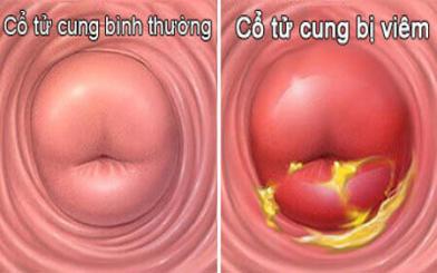 Bệnh viêm cổ tử cung là gì, nguyên nhân, triệu chứng và cách điều trị