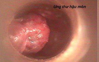 Những điều bạn cần biết về hình ảnh ung thư hậu môn