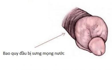 Bao quy đầu bị sưng mọng nước là bị làm sao?