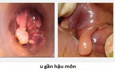 Xuất hiện khối u gần hậu môn chớ dại mà chủ quan