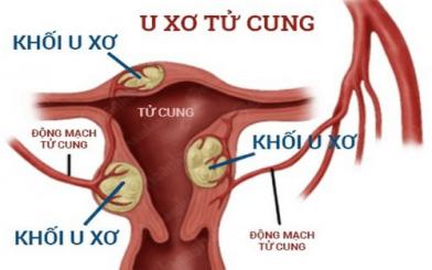 Bệnh u xơ tử cung: Nguyên nhân, triệu chứng và phương pháp điều trị